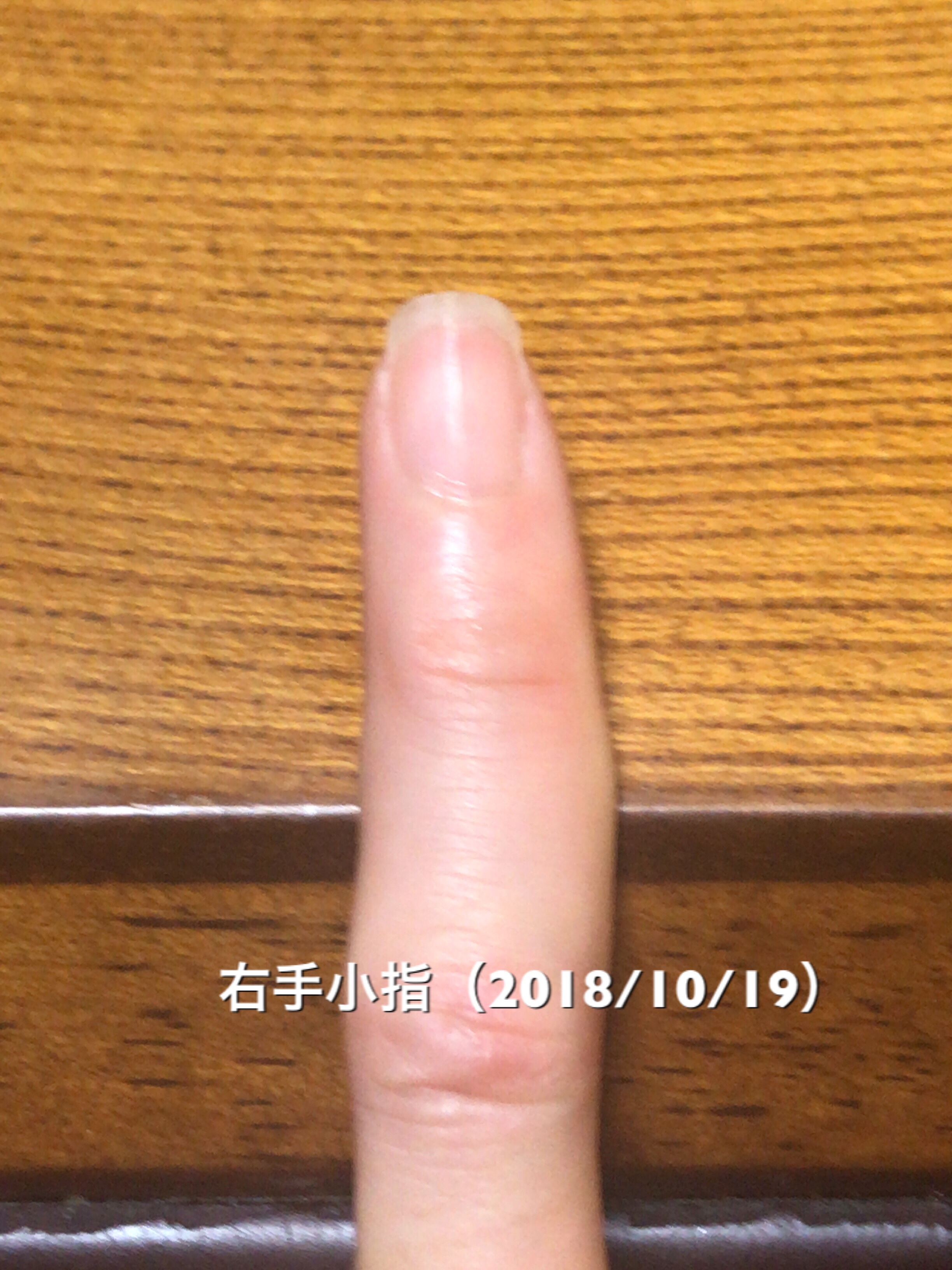 小指はかなり理想的な縦長になりつつあります。うまくうつせていませんが、ハイポニキウムも順調な成長。小指、薬指あたりをモデルケースに他の指の爪の形成を頑張っていきたいところです。という写真