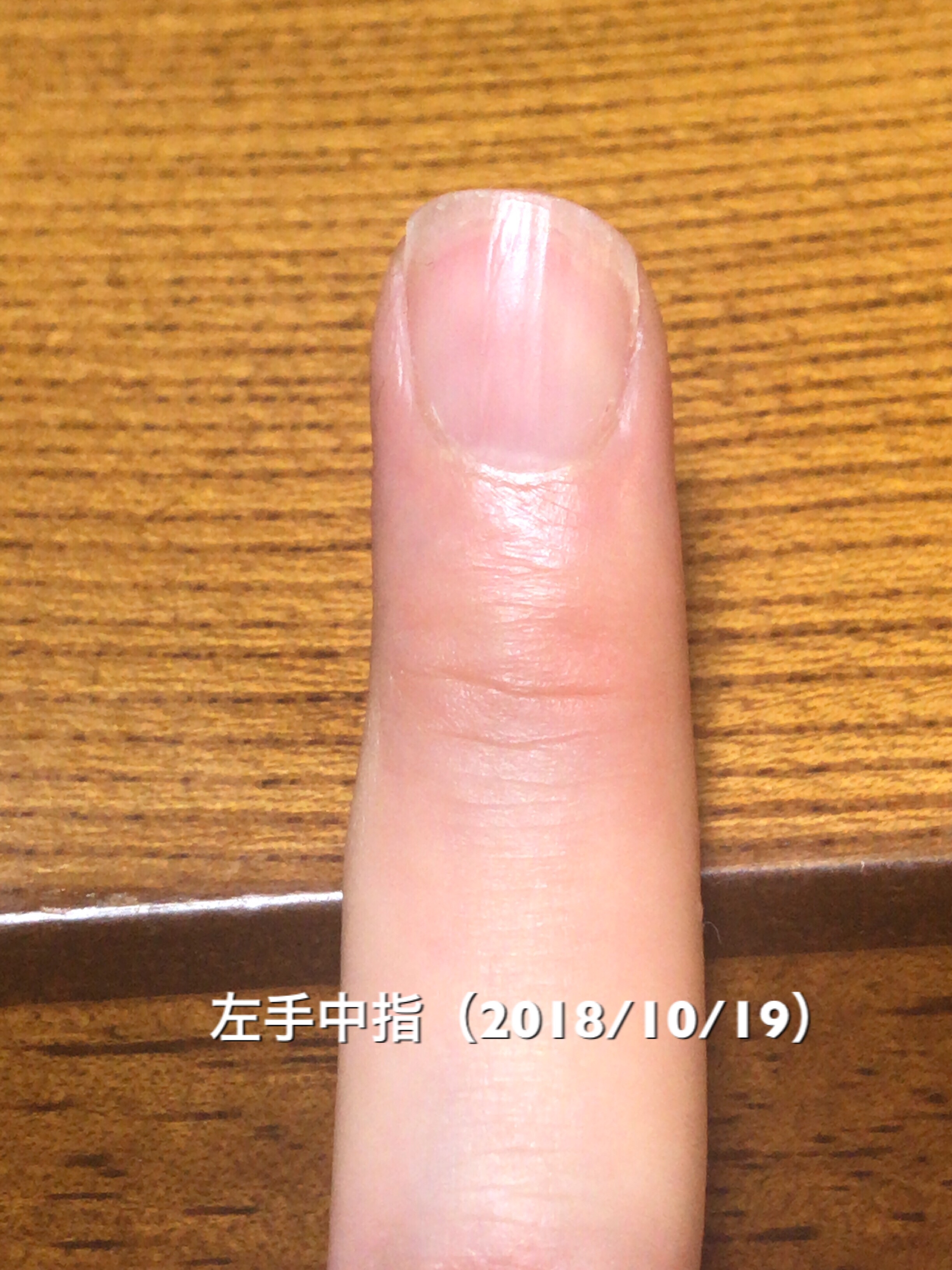 左手薬指は、中央部分のハイポニキウムの成長が著しく、サイド部分がそれに続くような仕上がりに。乾燥具合とかそういった影響でしょうか？左右差ありますが、サイドラインも着々と形成。均等に形を整えていきたいところです。という写真