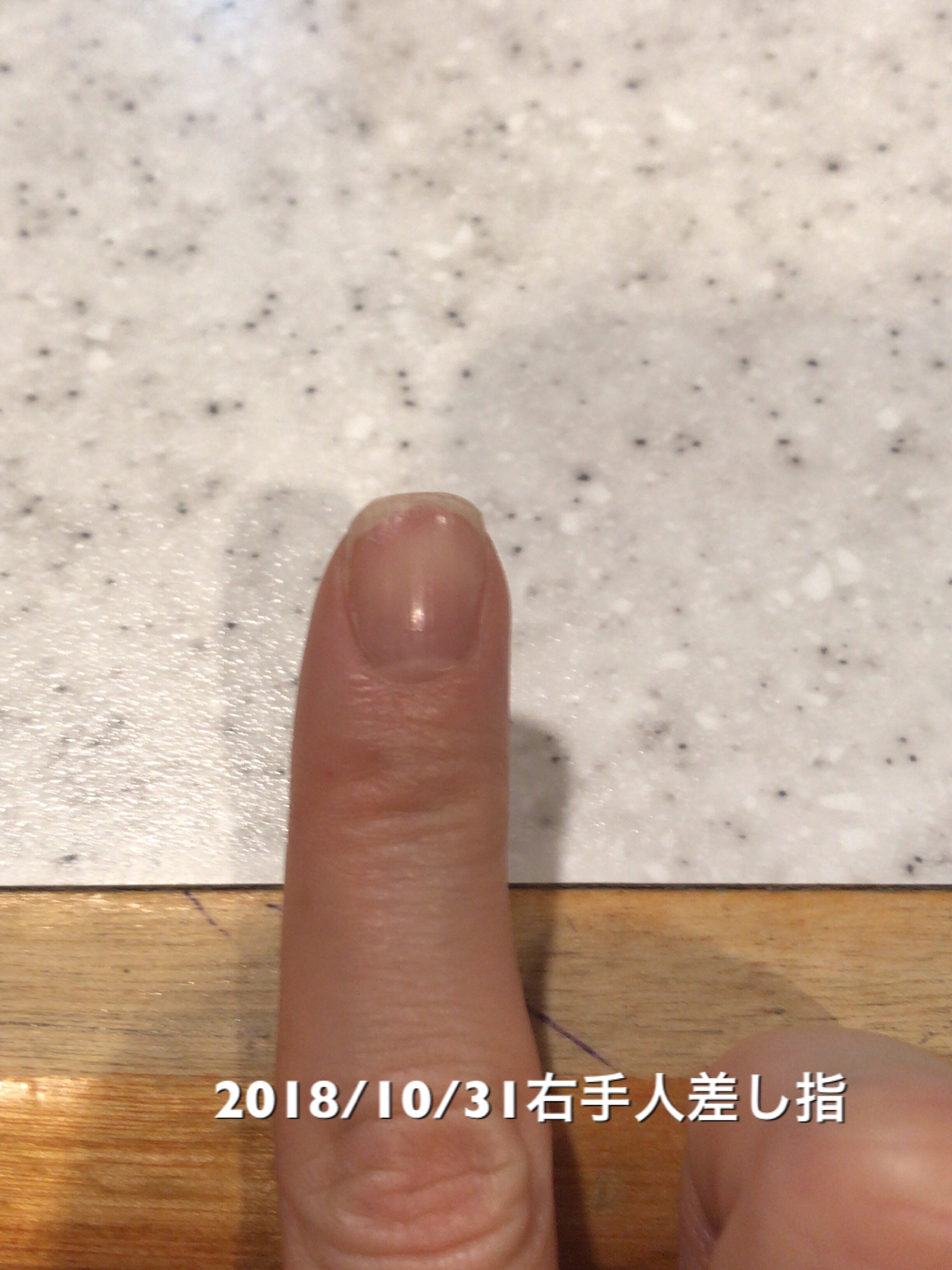 右手人差し指は、10日前と比べてネイルベッドの全長が1mm成長。よく使うのですぐ先が割れたりトラブル続きですが、めげずに頑張りたいところです。