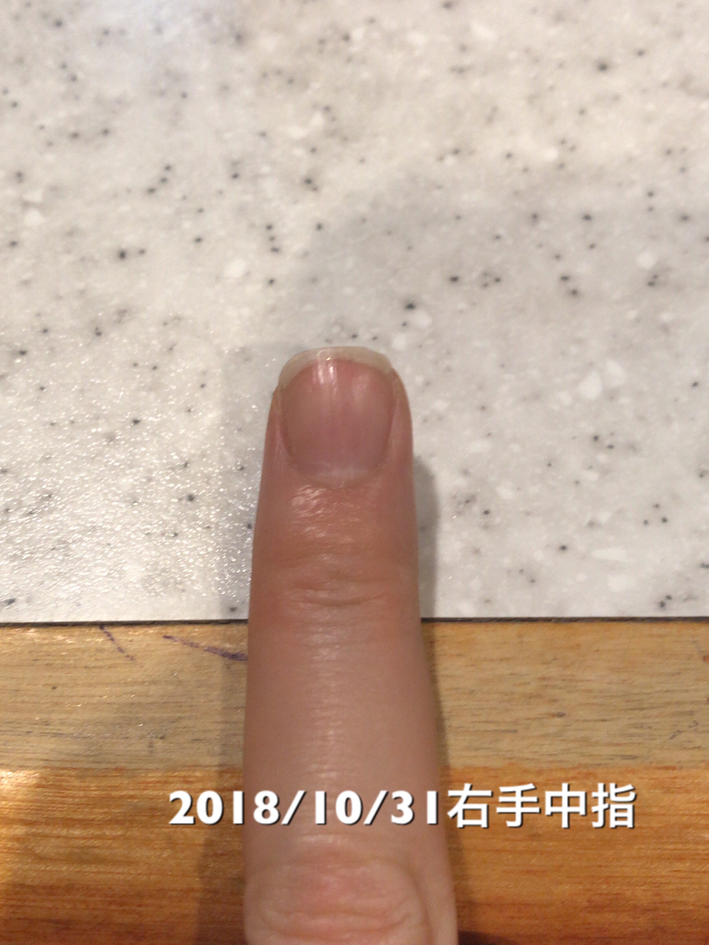 右手中指は、10日前との比較で、ネイルベッドが2mmの成長。
