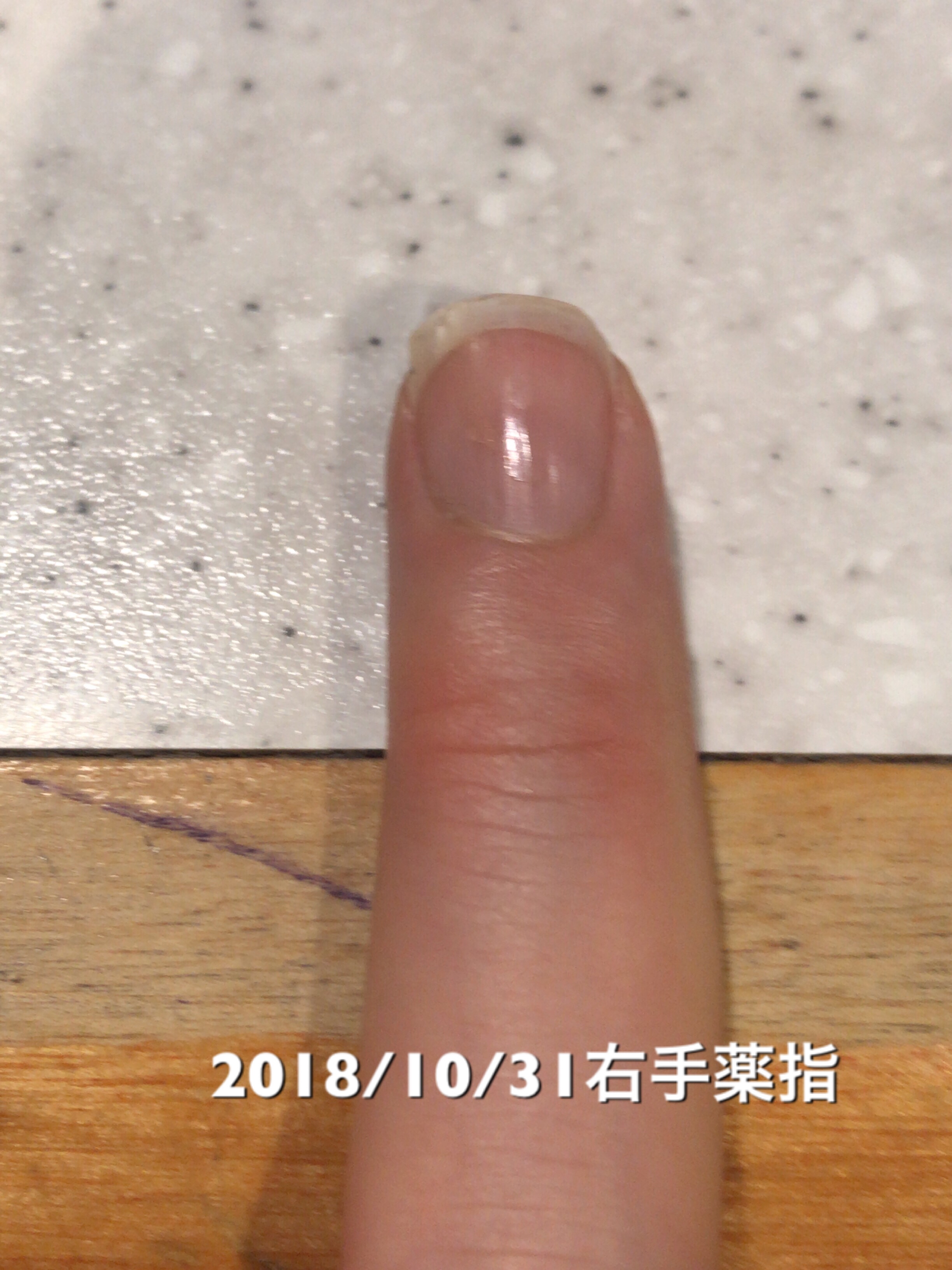 右手薬指は今回は変化なし。