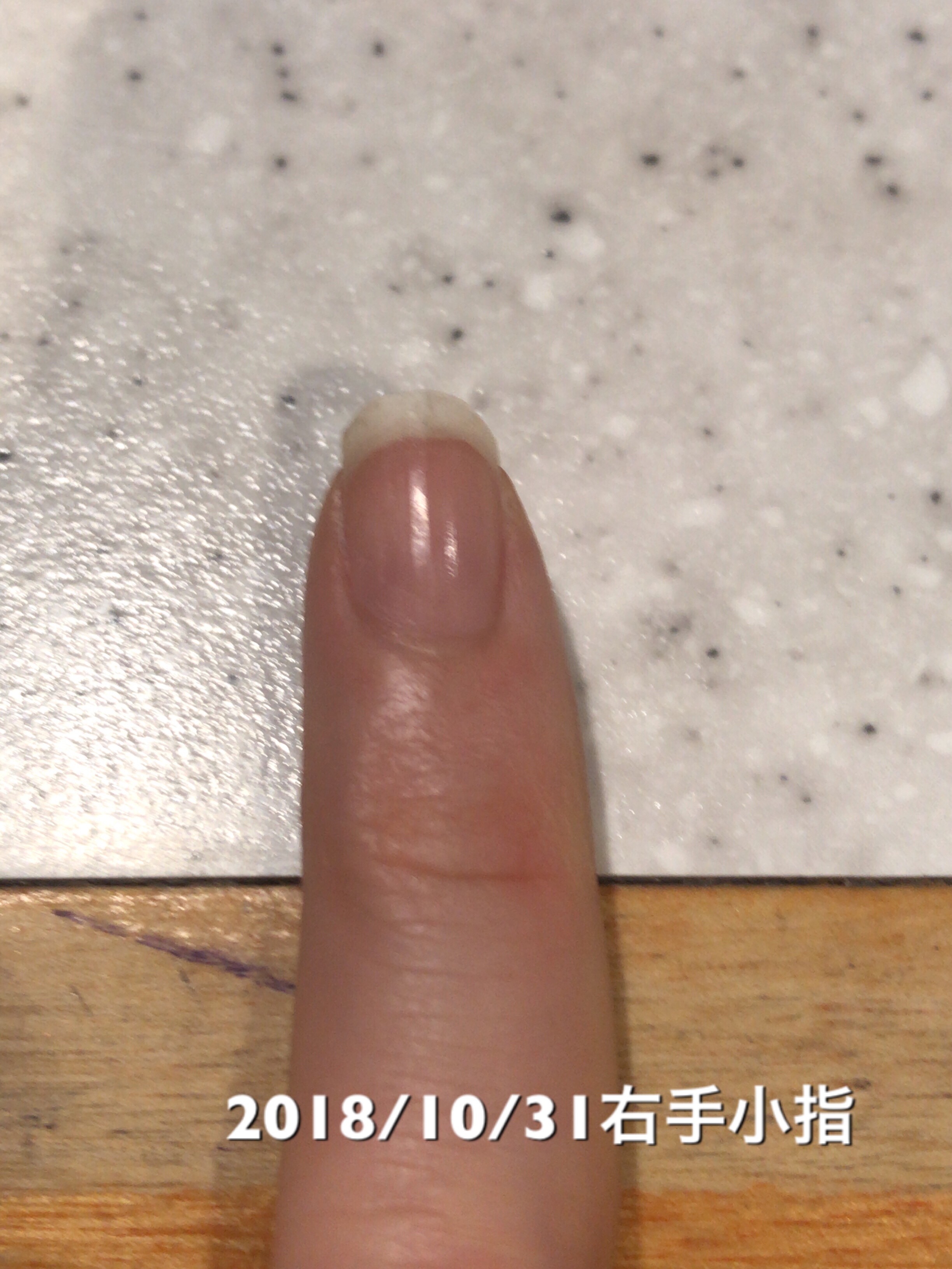 小指もネイルベッドが１ｍｍ成長。小指はネイルベッドの長さも形も満足できる形に近づきつつある印象。という写真