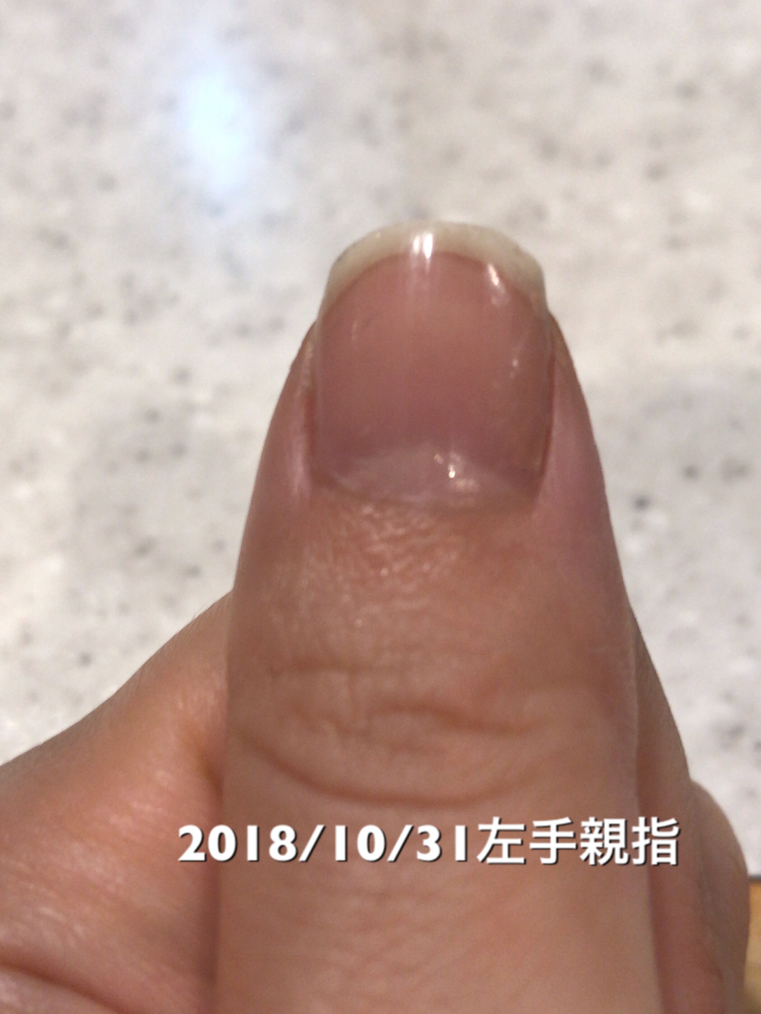 左手親指も一週間前から長さ面では変化なし。