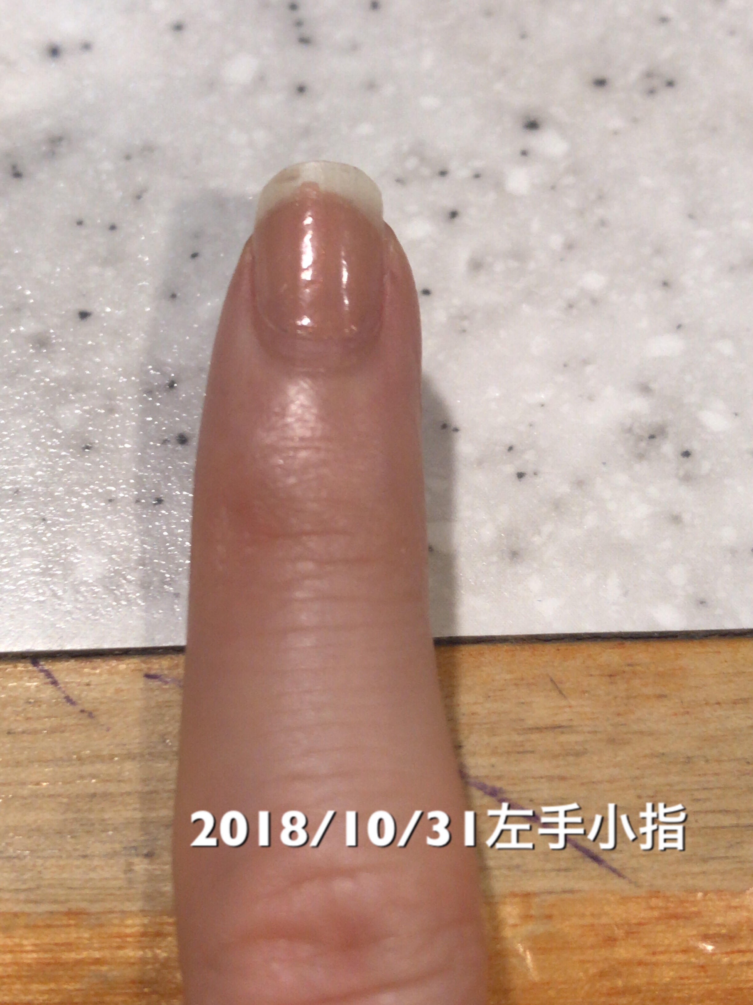 小指は数値面では10日前と変化なしですが、サイドラインがより一層くっきりしてきたと感じます。マニキュアの落とし残しが映ってしまってますが、マニキュアを塗るとほっそりした爪になってちょっと嬉しいです。という写真